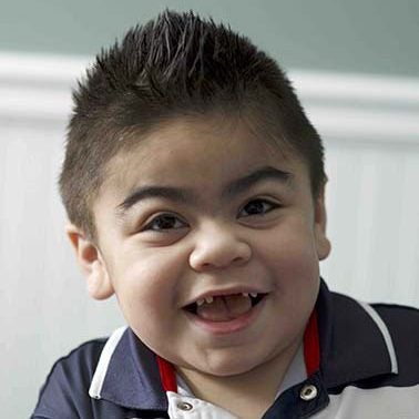Hunter syndrome patient with distinctive facial features.