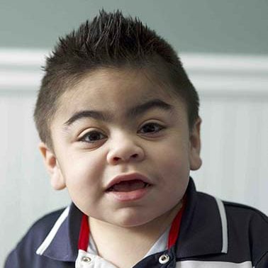 hunter syndrome baby